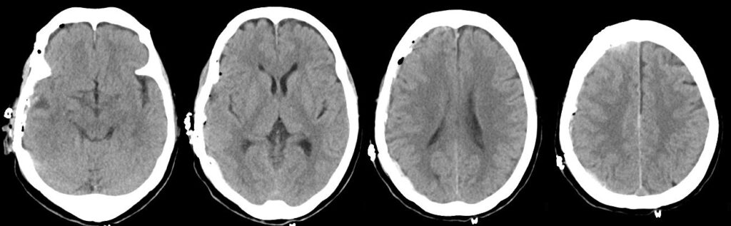 右急性硬膜下血腫（Rt.ASDH）の術後（軽快例）の単純CT画像