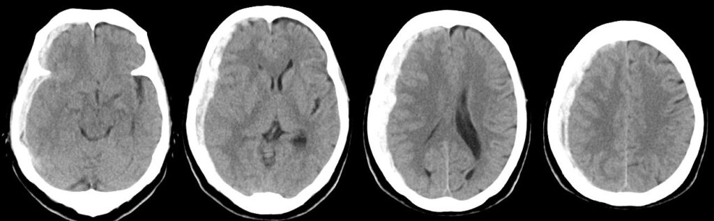 右急性硬膜下血腫（Rt.ASDH）の単純CT画像
