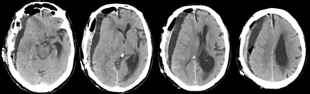 右急性硬膜下血腫（Rt.ASDH）の術後（重症例）の単純CT画像