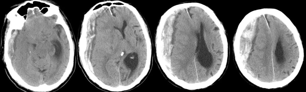 右急性硬膜下血腫（Rt.ASDH）の術前（重症例）の単純CT画像