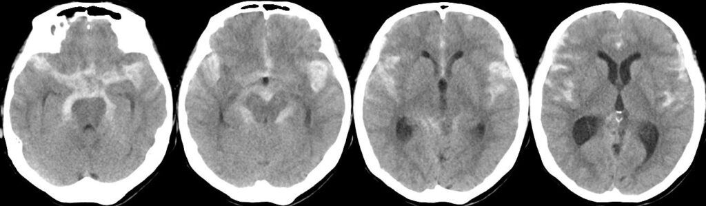 くも膜下出血（破裂脳動脈瘤）の単純CT画像