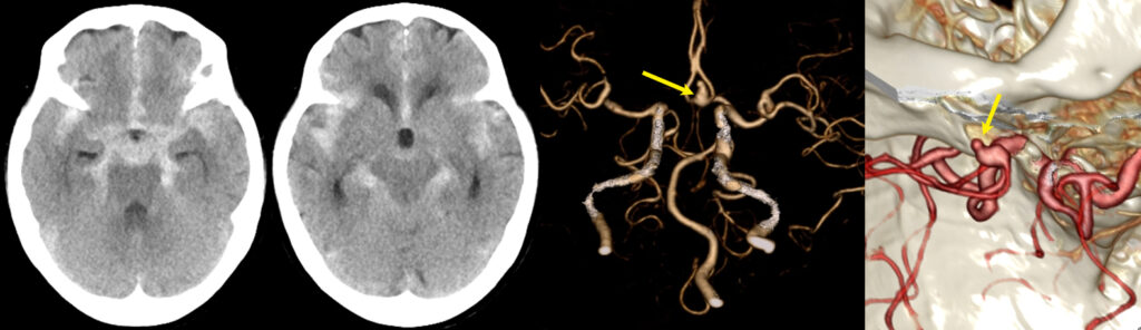 くも膜下出血（破裂脳動脈瘤）の単純CTと3D-CTA画像