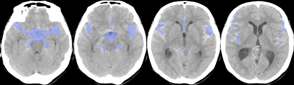 くも膜下出血（破裂脳動脈瘤）の単純CT画像の色付け