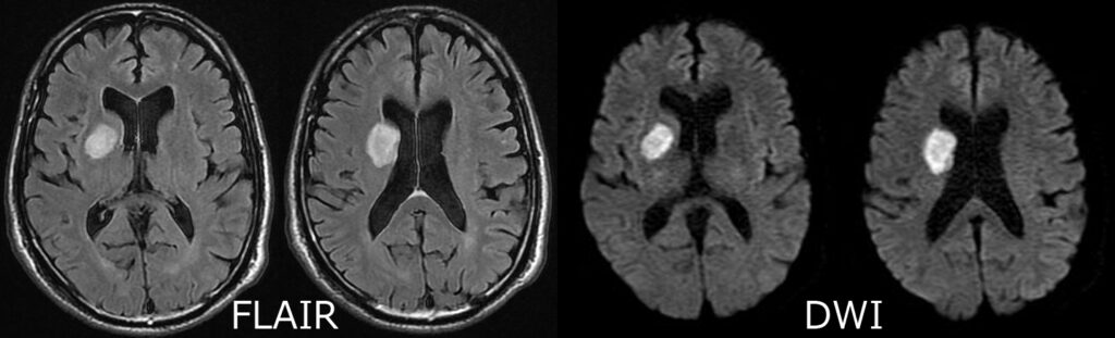 アテローム血栓性脳梗塞のMRI画像（FLAIRとDWI）