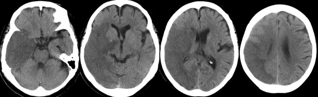 心原性脳塞栓症の頭部単純CT画像