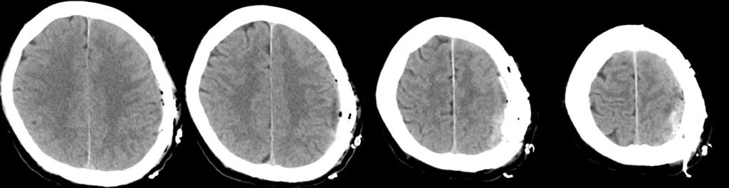 左急性硬膜外血腫術後の頭部単純CT画像