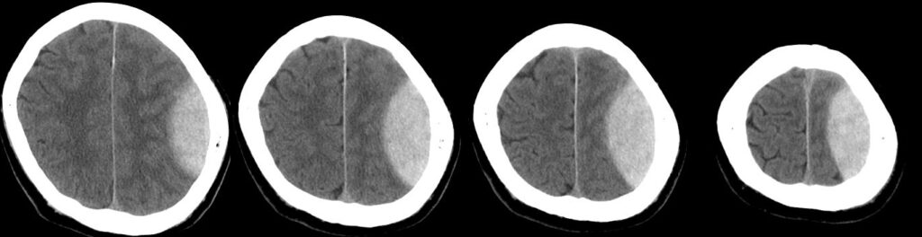 左急性硬膜外血腫（Lt.AEDH）の単純CT画像