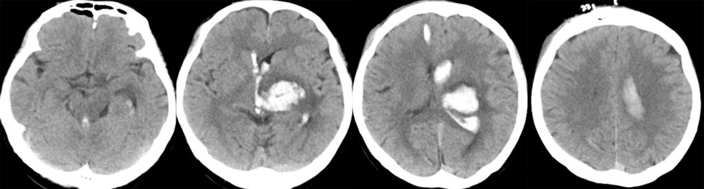 脳出血（左視床出血）に閉塞性水頭症を合併しており、持続脳室ドレナージ術（CVD）が施行された例