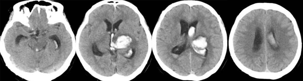 脳出血（左視床出血）に閉塞性水頭症を合併している頭部単純CT画像