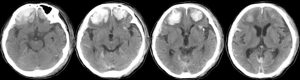 両側前頭葉脳挫傷の頭部単純CT画像
