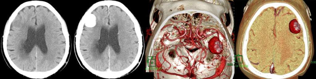 単純CTと、いろいろな造影CTの画像比較