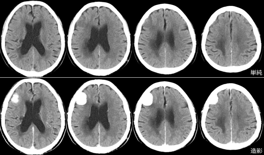 右前頭円蓋部髄膜種の頭部単純CTと、頭部造影CTの画像比較。