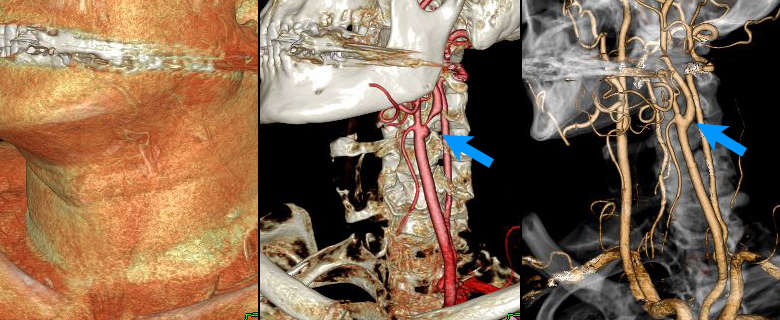 左頚部内頚動脈狭窄症の3D-CTA画像（CEAの術前と術後の比較）