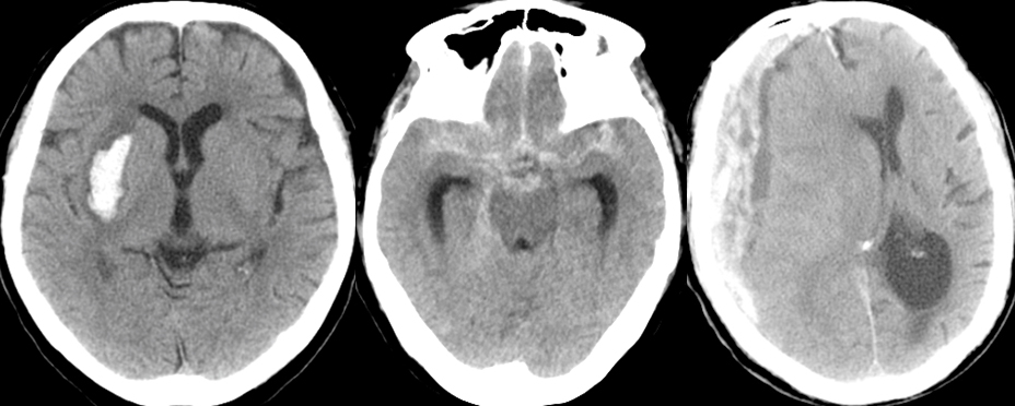 出血性病変の頭部単純CT画像。左から脳出血、くも膜下出血、急性硬膜下血腫。