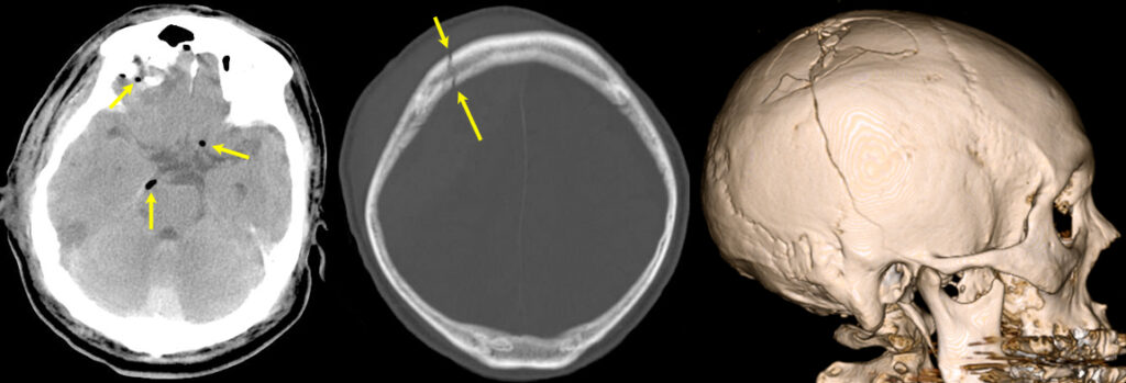 頭部外傷の頭部単純CT画像。左から気脳症（髄液漏）、頭蓋骨亀裂骨折、頭蓋骨粉剤陥没骨折