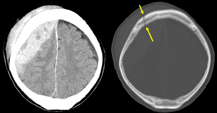 頭蓋骨骨折を伴う急性硬膜外血腫の頭部単純CT画像