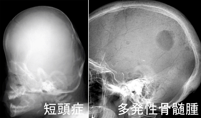 頭蓋縫合早期癒合症による短頭症と、多発性骨髄腫の頭部単純Xp画像