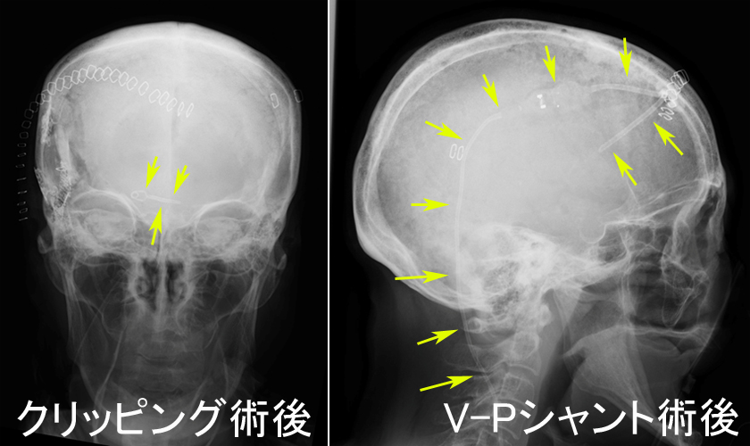 クリッピング術後とV-Pシャント術後の頭部単純Xp画像