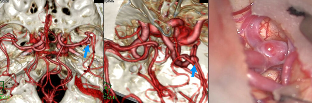 未破裂右中大脳動脈瘤の術前3D-CTAと、実際の術野画像（クリッピング前）