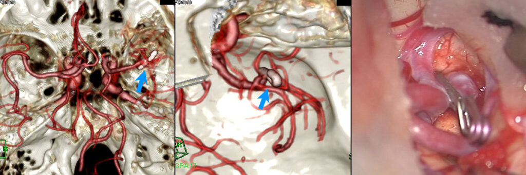 未破裂右中大脳動脈瘤の術前3D-CTAと、実際の術野画像（クリッピング後）