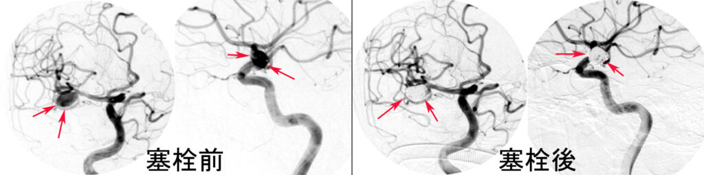 コイル塞栓術の脳血管撮影画像