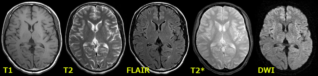 頭部単純MRIの色々な撮影方法