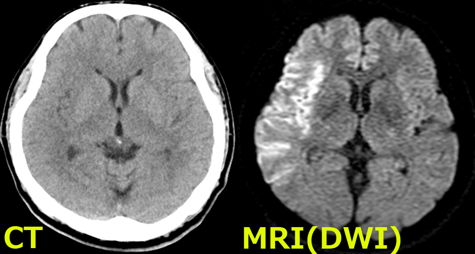 超急性期脳梗塞のCT/MRI比較