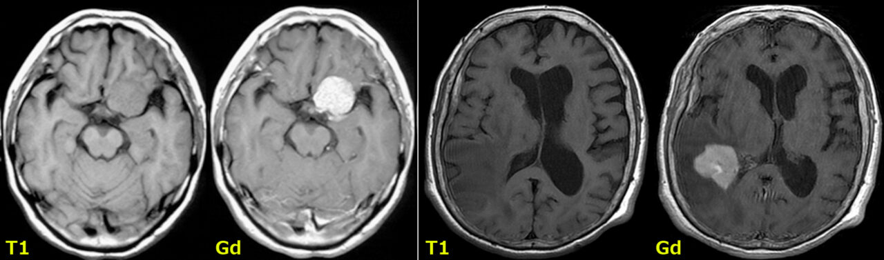 ガドリニウム造影による脳腫瘍の増強効果