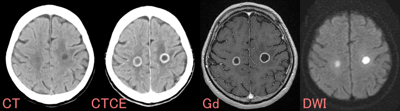 多発脳膿瘍のCT/MRI所見