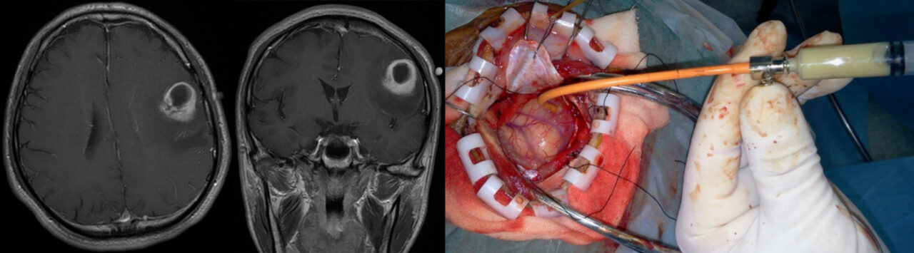 脳膿瘍の術前MRIと術中所見（脳膿瘍を穿刺吸引しているところ）