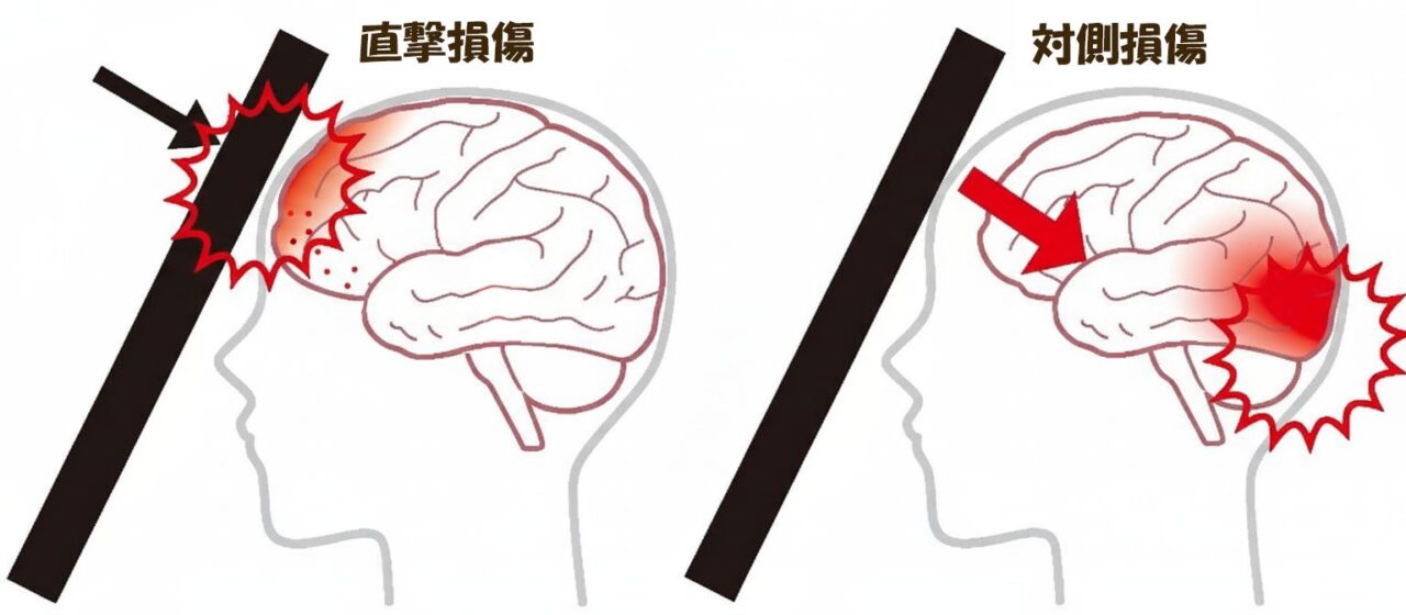 頭部外傷における直撃損傷(coup injury)と対側損傷(contrecoup injury)のメカニズムを示した図解